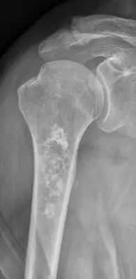Radiograph from the case bank: Enchondroma