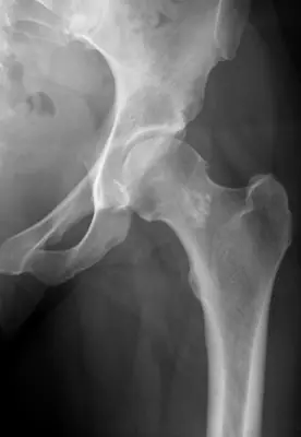 Radiograph from the case bank: Enchondroma