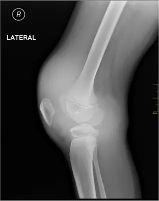 Radiograph from the case bank: Knee joint effusion
