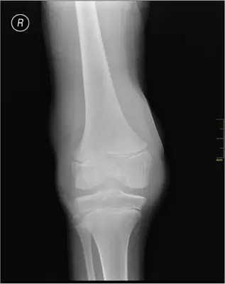 Radiograph from the case bank: Knee joint effusion
