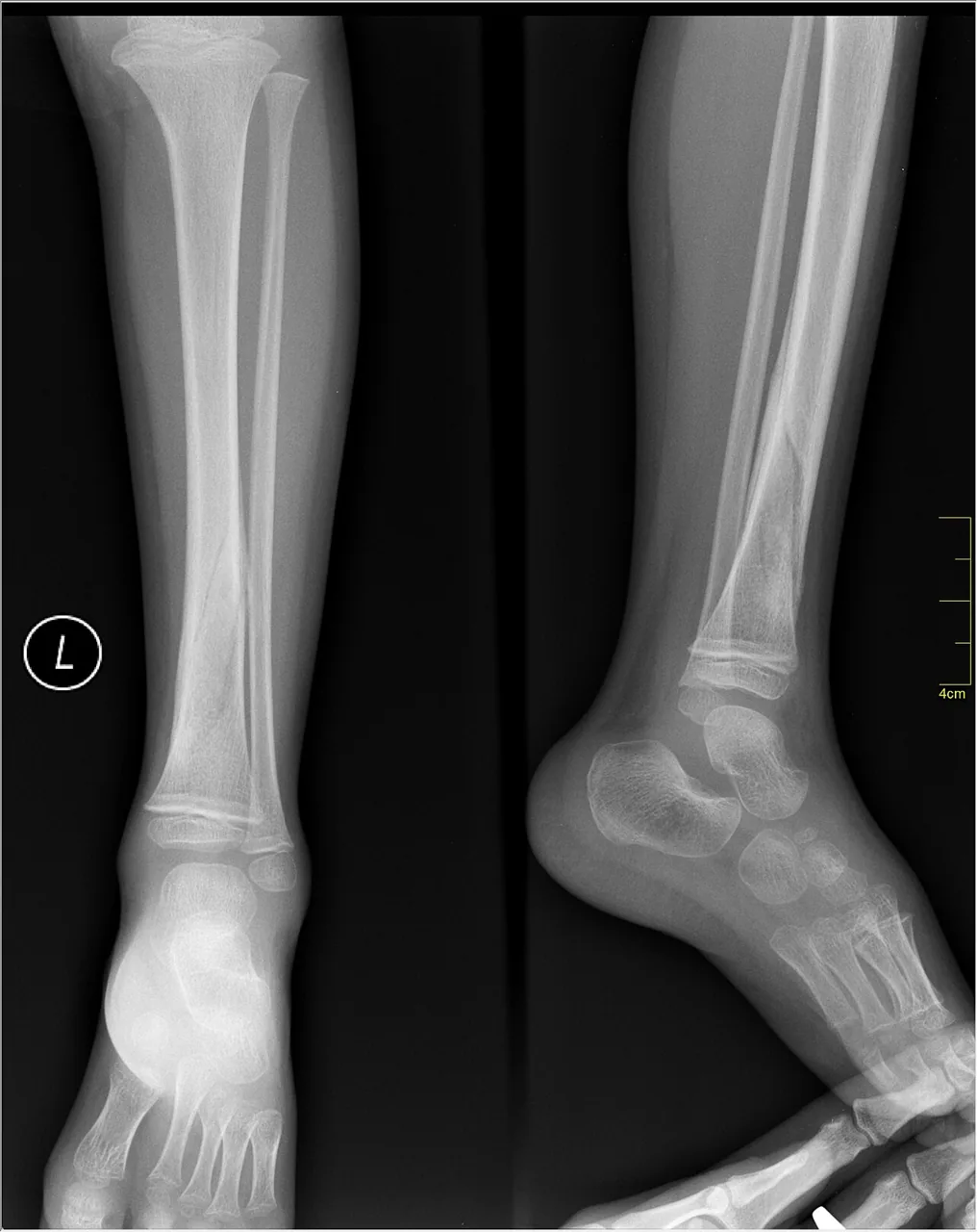 Lower limb radiograph for self-assessment