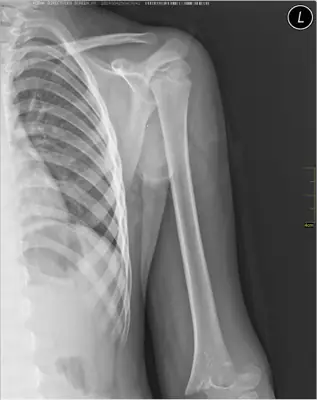 Radiograph from the case bank: Proximal humerus fracture