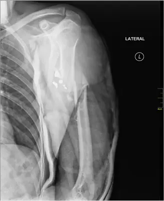 Radiograph from the case bank: Humeral shaft fracture