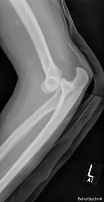 Radiograph from the case bank: Elbow dislocation
