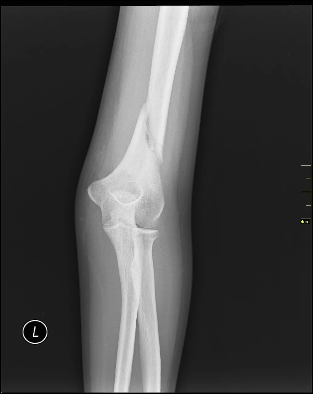 Upper limb radiograph for self-assessment