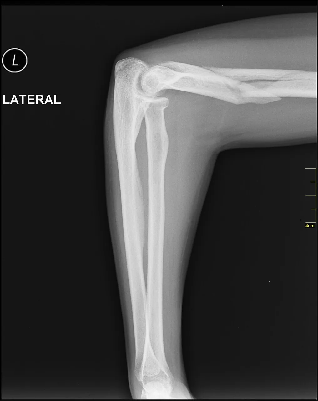 Upper limb radiograph for self-assessment