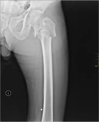 Radiograph from the case bank: Hip (proximal femoral) fracture