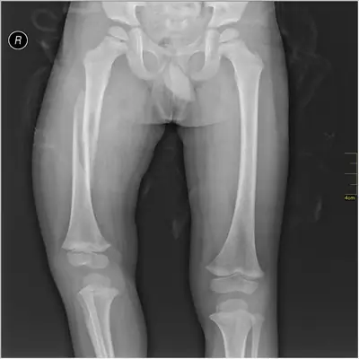Radiograph from the case bank: Femoral shaft fracture