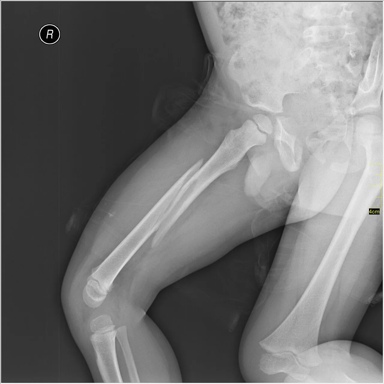Lower limb radiograph for self-assessment