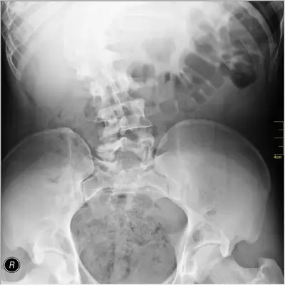 Radiograph from the case bank: Scoliosis