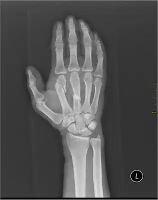 Radiograph from the case bank: Metacarpal fracture