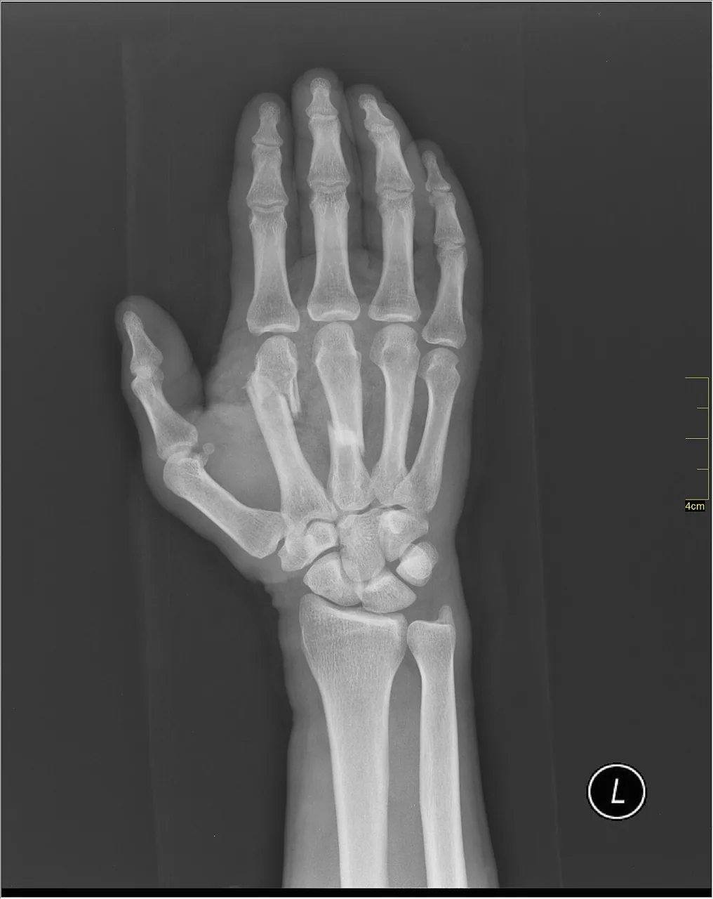Upper limb radiograph for self-assessment