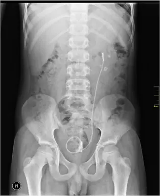 Radiograph from the case bank: Urinary tract calculi (kidney or ureteric stones)