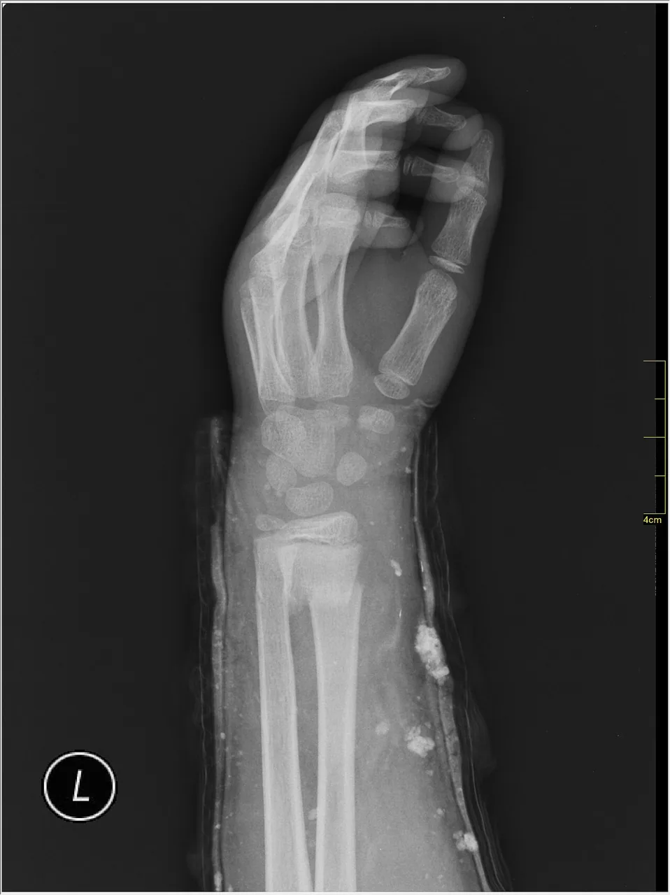 Upper limb radiograph for self-assessment