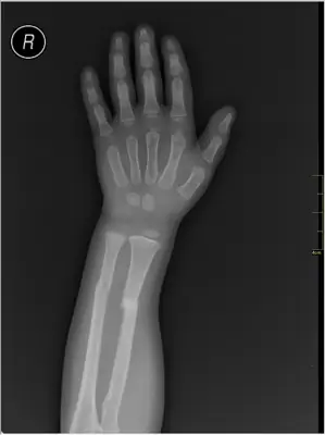 Radiograph from the case bank: Forearm shaft fracture (radius and ulna)