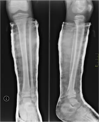 Radiograph from the case bank: Tibial (and fibular) shaft fracture