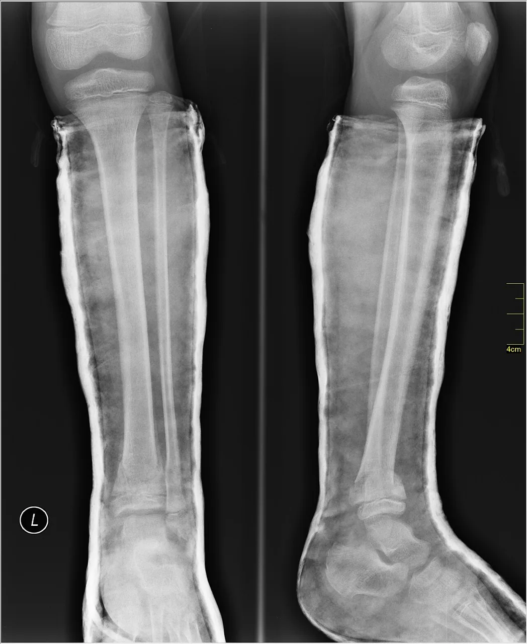 Lower limb radiograph for self-assessment