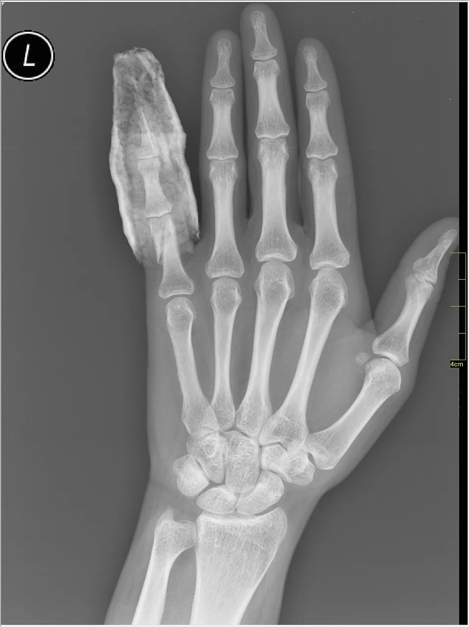 Upper limb radiograph for self-assessment