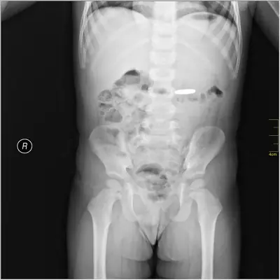 Radiograph from the case bank: Foreign body (ingested or inserted)