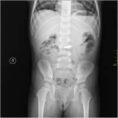 Radiograph from the case bank: Foreign body (ingested or inserted)