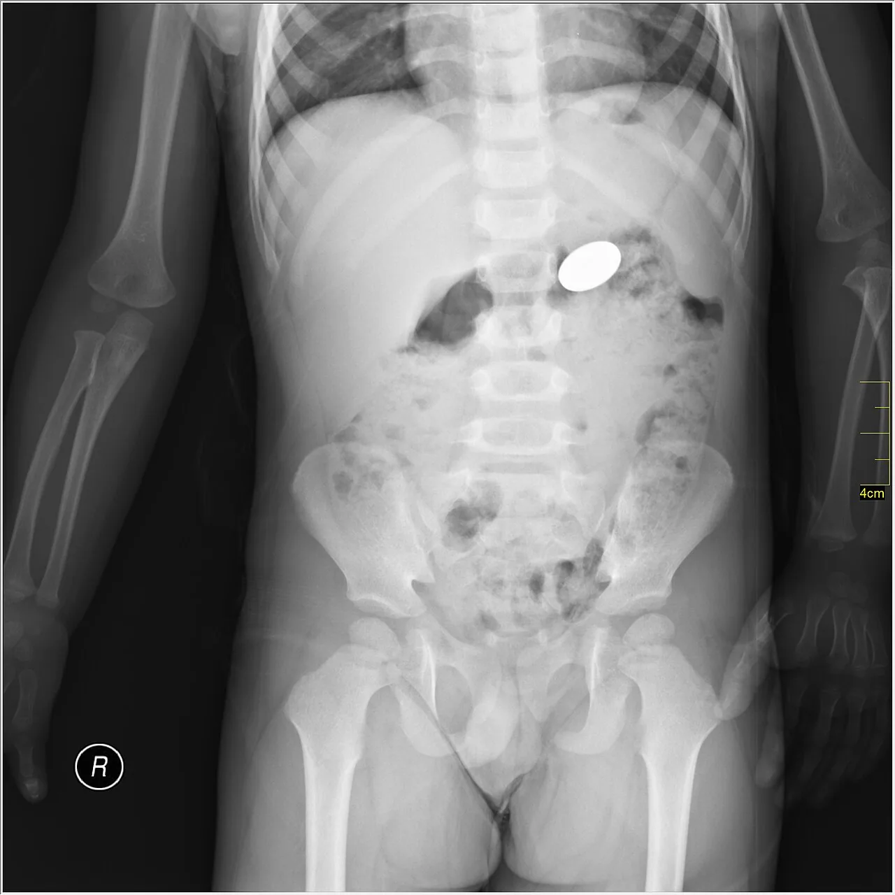 Abdomen radiograph for self-assessment