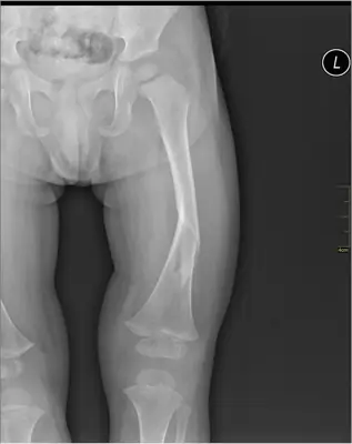 Radiograph from the case bank: Femoral shaft fracture