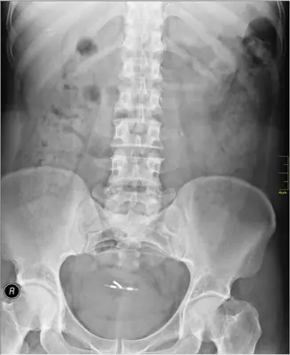 Radiograph from the case bank: Intrauterine contraceptive device (IUCD)
