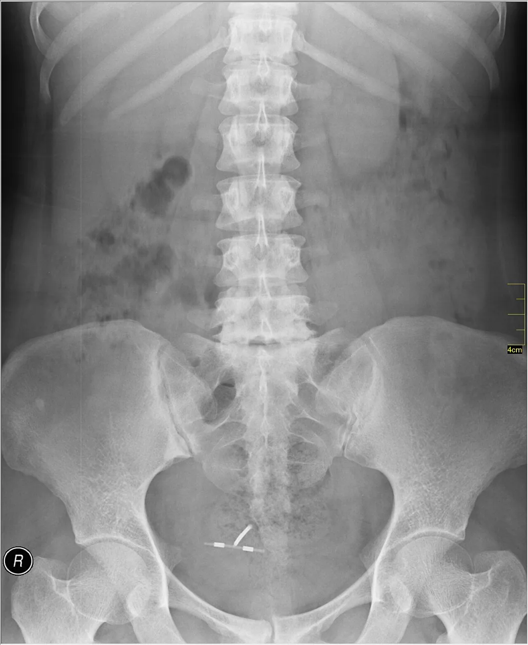 Abdomen radiograph for self-assessment