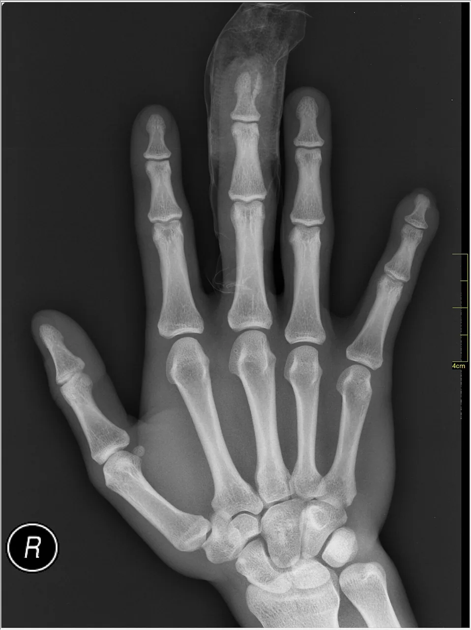 Upper limb radiograph for self-assessment