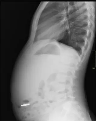 Radiograph from the case bank: Foreign body (ingested or inserted)
