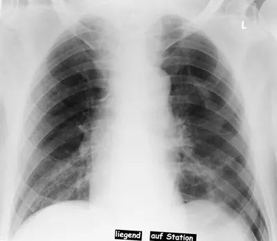 Radiograph from the case bank: Pneumothorax