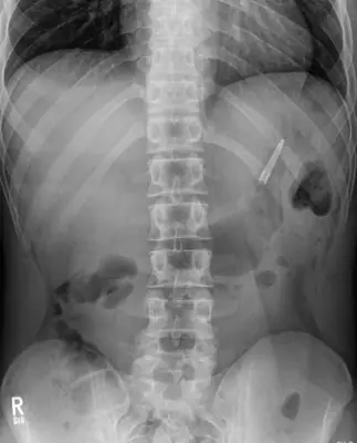 Radiograph from the case bank: Foreign body (ingested or inserted)