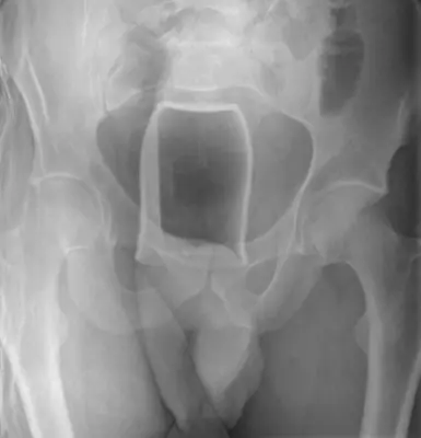 Radiograph from the case bank: Foreign body (ingested or inserted)