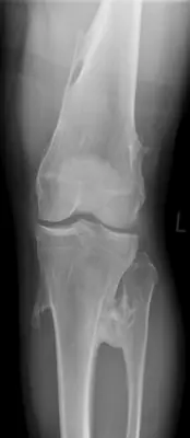Radiograph from the case bank: Osteochondroma (exostosis)