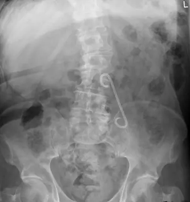 Radiograph from the case bank: Foreign body (ingested or inserted)