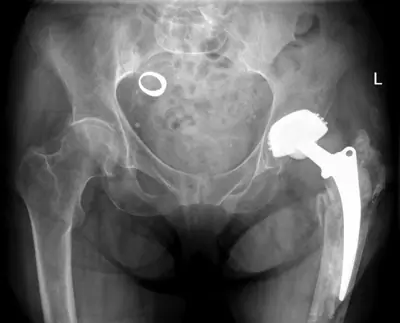 Radiograph from the case bank: Foreign body (ingested or inserted)