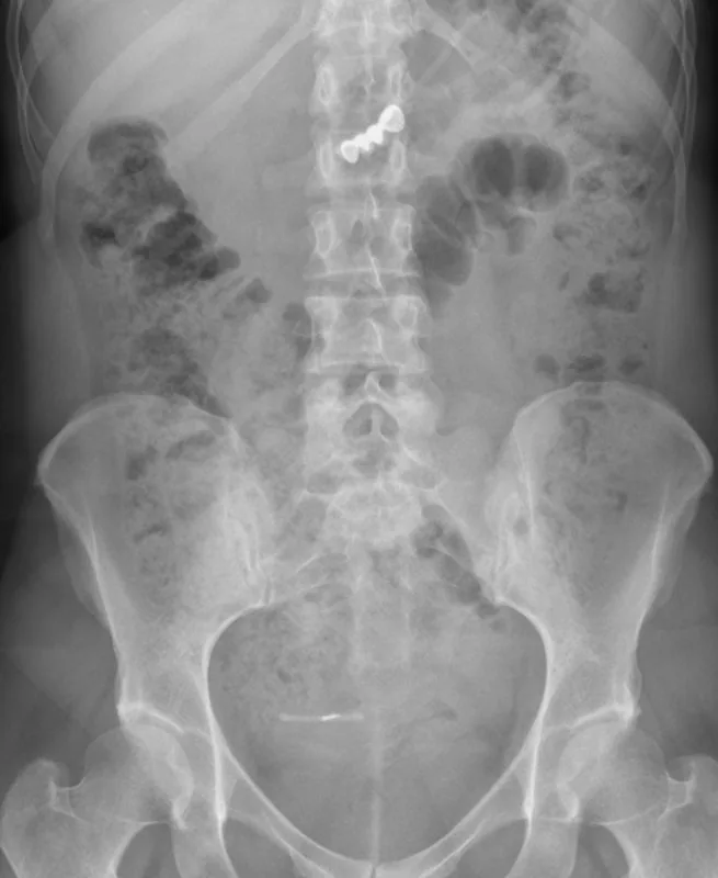 Abdomen radiograph for self-assessment