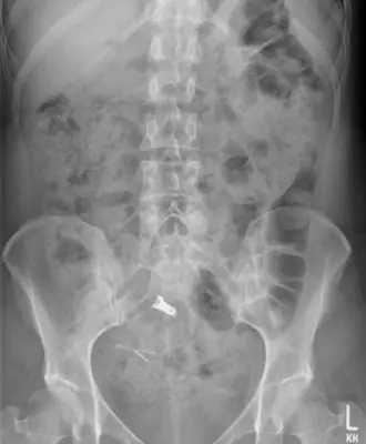 Radiograph from the case bank: Foreign body (ingested or inserted)