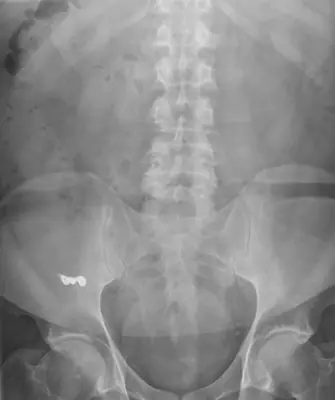 Radiograph from the case bank: Foreign body (ingested or inserted)