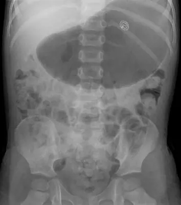 Radiograph from the case bank: Foreign body (ingested or inserted)