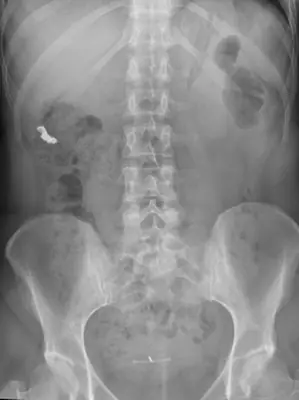 Radiograph from the case bank: Foreign body (ingested or inserted)