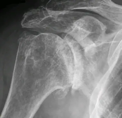 Radiograph from the case bank: Osteoarthritis