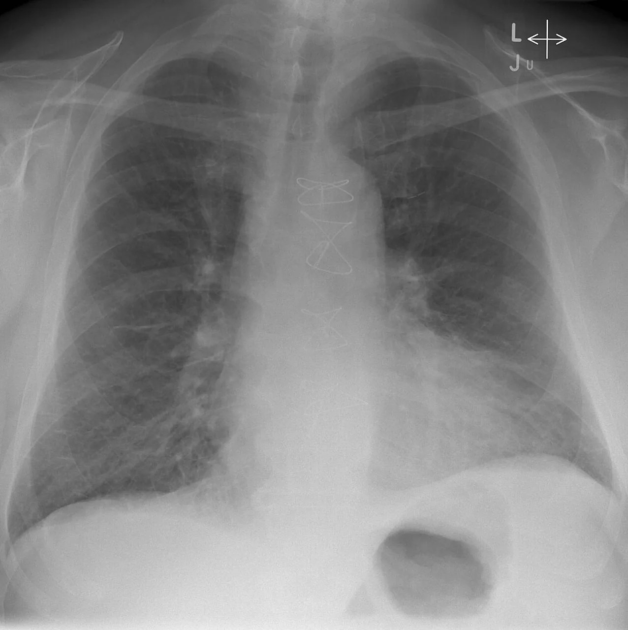 Chest radiograph for self-assessment