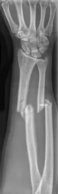 Radiograph from the case bank: Forearm shaft fracture (radius and ulna)