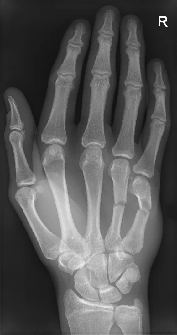 Upper limb radiograph for self-assessment