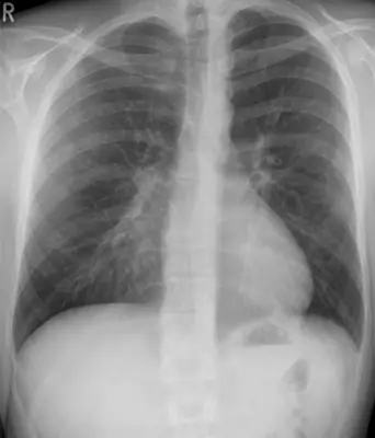 Radiograph from the case bank: Pectus excavatum