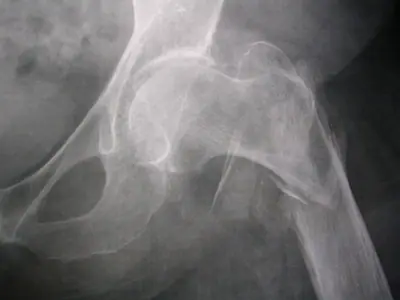 Radiograph from the case bank: Hip (proximal femoral) fracture