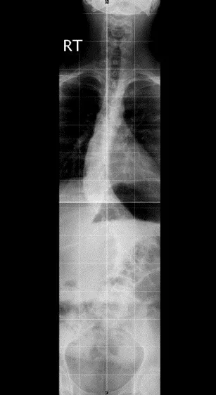 Spine radiograph for self-assessment