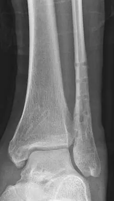 Radiograph from the case bank: Bimalleolar ankle fracture