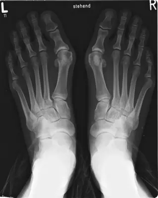 Radiograph from the case bank: Hallux valgus (bunion)